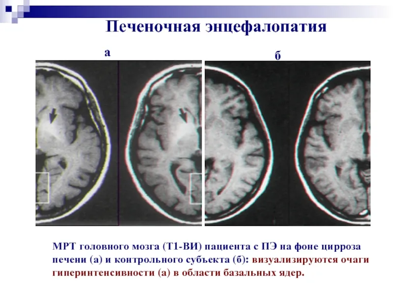 печеночная энцефалопатия